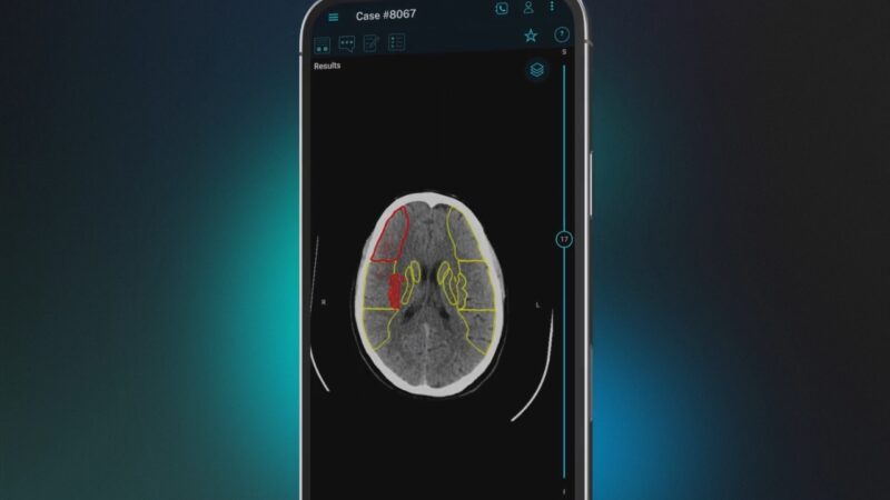 AI Stroke Imaging Helps Doctors Detect Brain Clots Faster