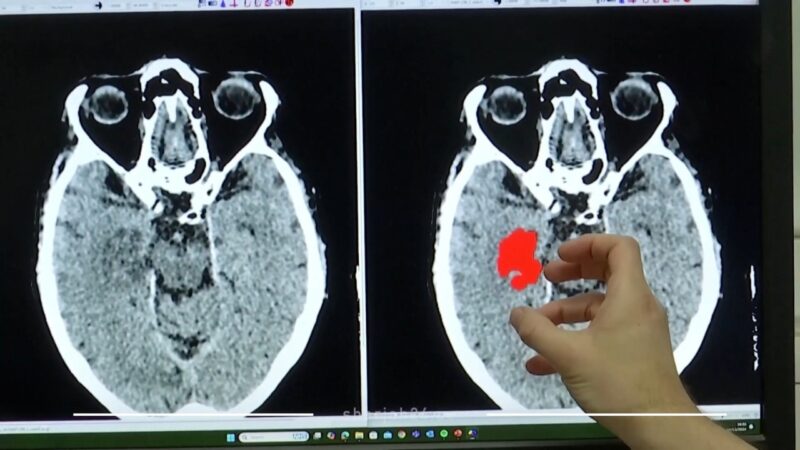 A hand points to a marked brain clot on a CT scan