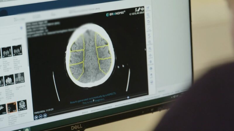 AI stroke scan results appear on a hospital monitor