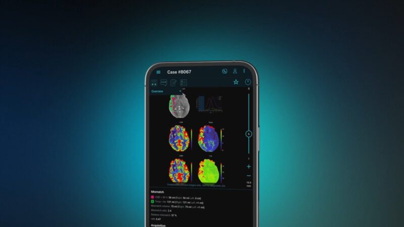 A phone displays AI brain scan results on a dark teal background